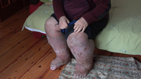 Sivrisinek ısırığıyla fil ayağı hastalığına yakalandı: 9 yıldır insan içine çıkamıyor 