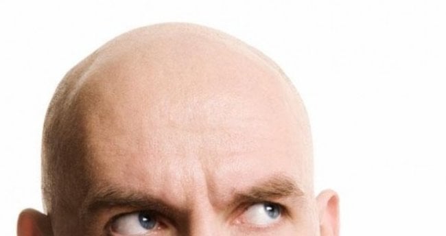 Saçları dökülmüş bir adamın kafası